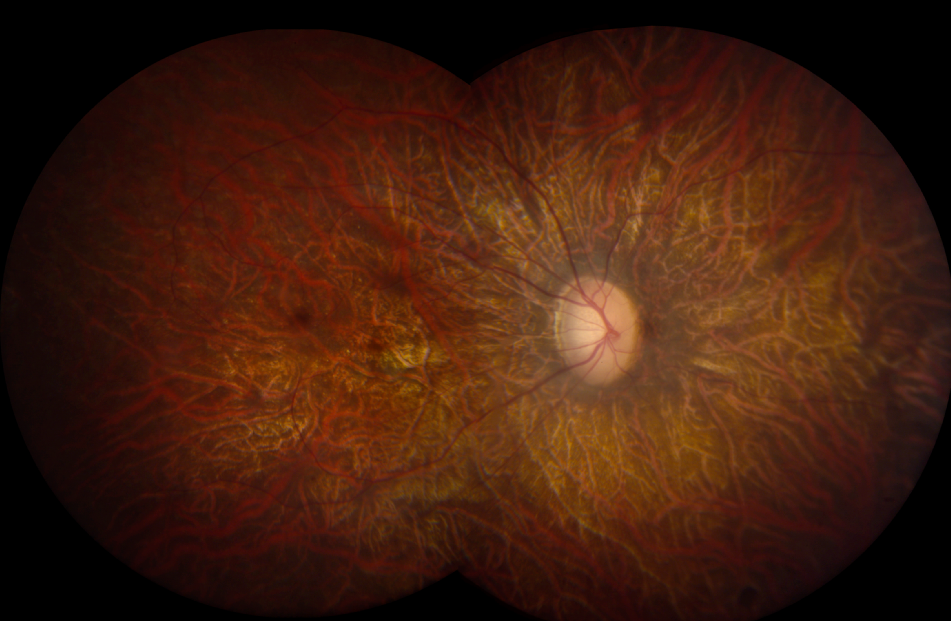 Eye clinical trials