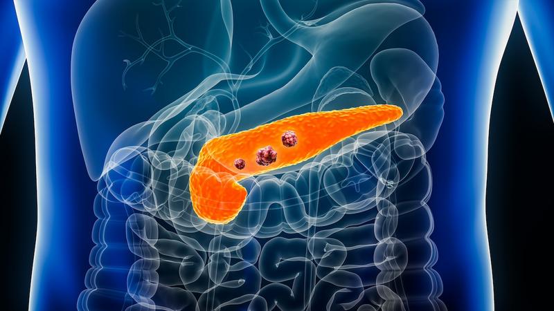 News: CRISPR Targets Pancreatic Cancer Mutations – CRISPR Medicine