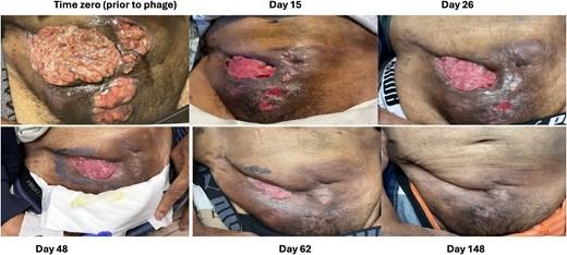 Figure 1. Abdominal wall lesions before and after initiation of adjunctive SNIPR001. Serial...